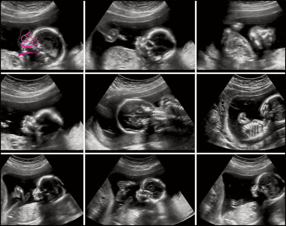 الحمل في الشهر الثالث بالصور
