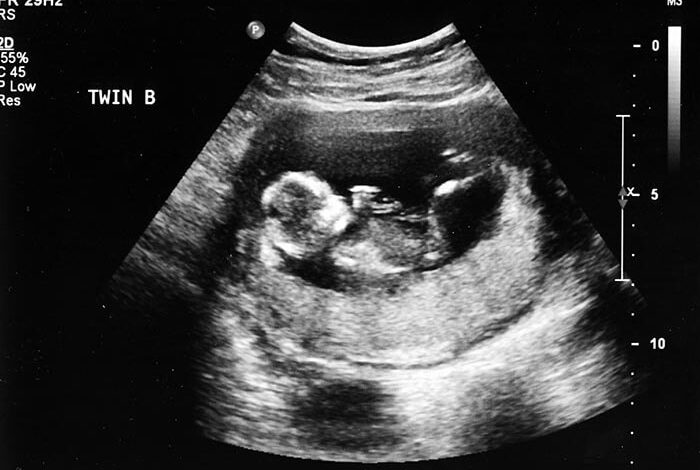 الخطأ في تحديد نوع الجنين في الشهر الخامس للأمانة العامة للجنة